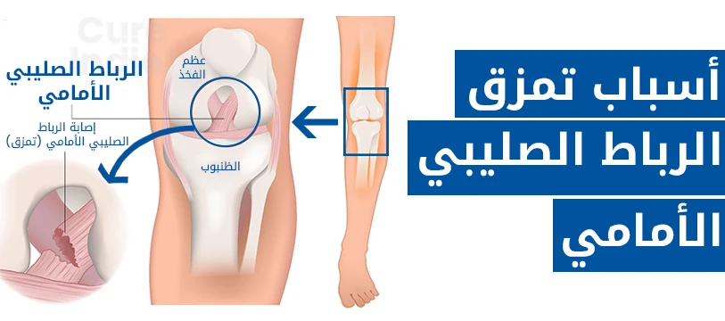 أسباب تمزق الرباط الصليبي الأمامي